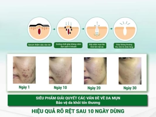 acne-serum-tri-mun-duong-da-mem-min-cang-bong