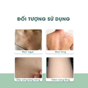 combo-kem-va-xit-follicas